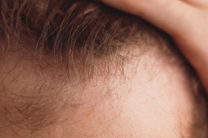 When To Consider a Hair Transplant When To Consider a Hair Transplant